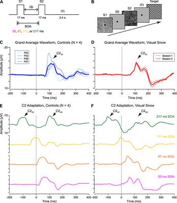 Distinct Patterns of P1 and C2 VEP Potentiation and Attenuation in Visual Snow: A Case Report